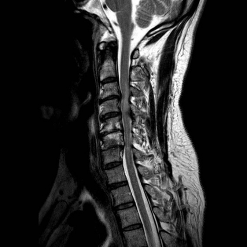MRI of the Cervical Spine Showing Cervical Stenosis